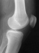 Prothese de genou, Ligaments croises, Menisques, Cartilage, Arthrose Amiens